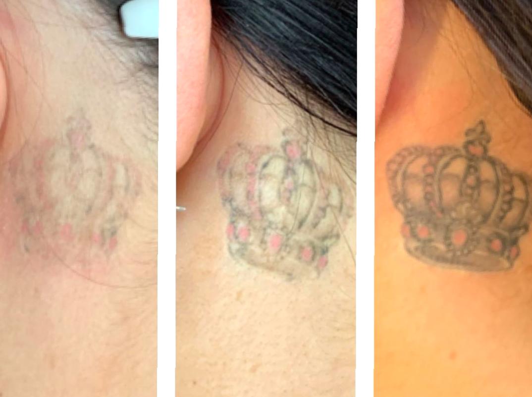 In-Depth Training Courses for Tattoo Removal Specialists