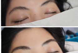 before and after combo brows sydney