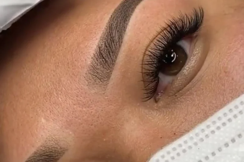 Saline Vs Alkaline Microblading Removal On Thin, Scarred Forehead Skin
