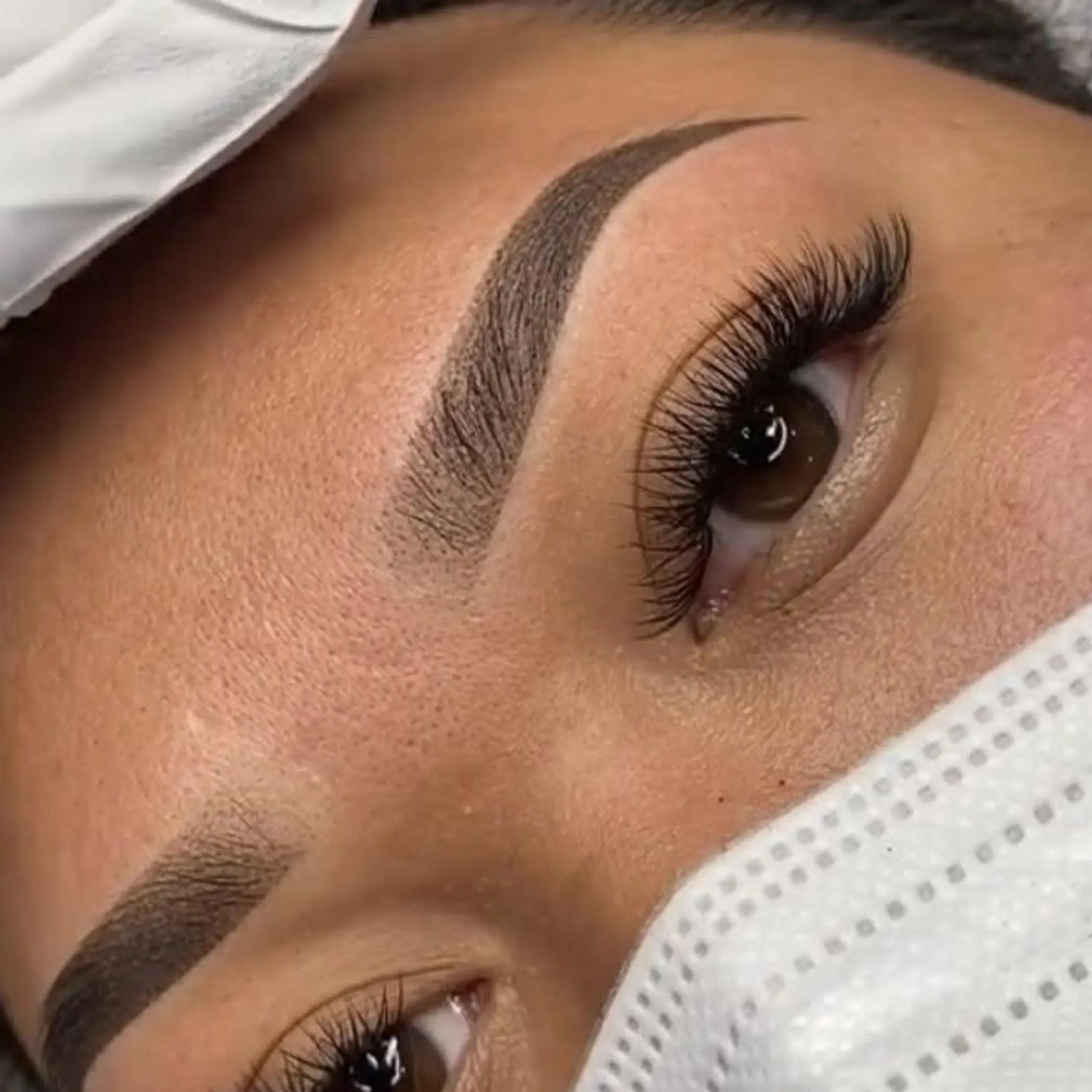 before and after saline removal forehead