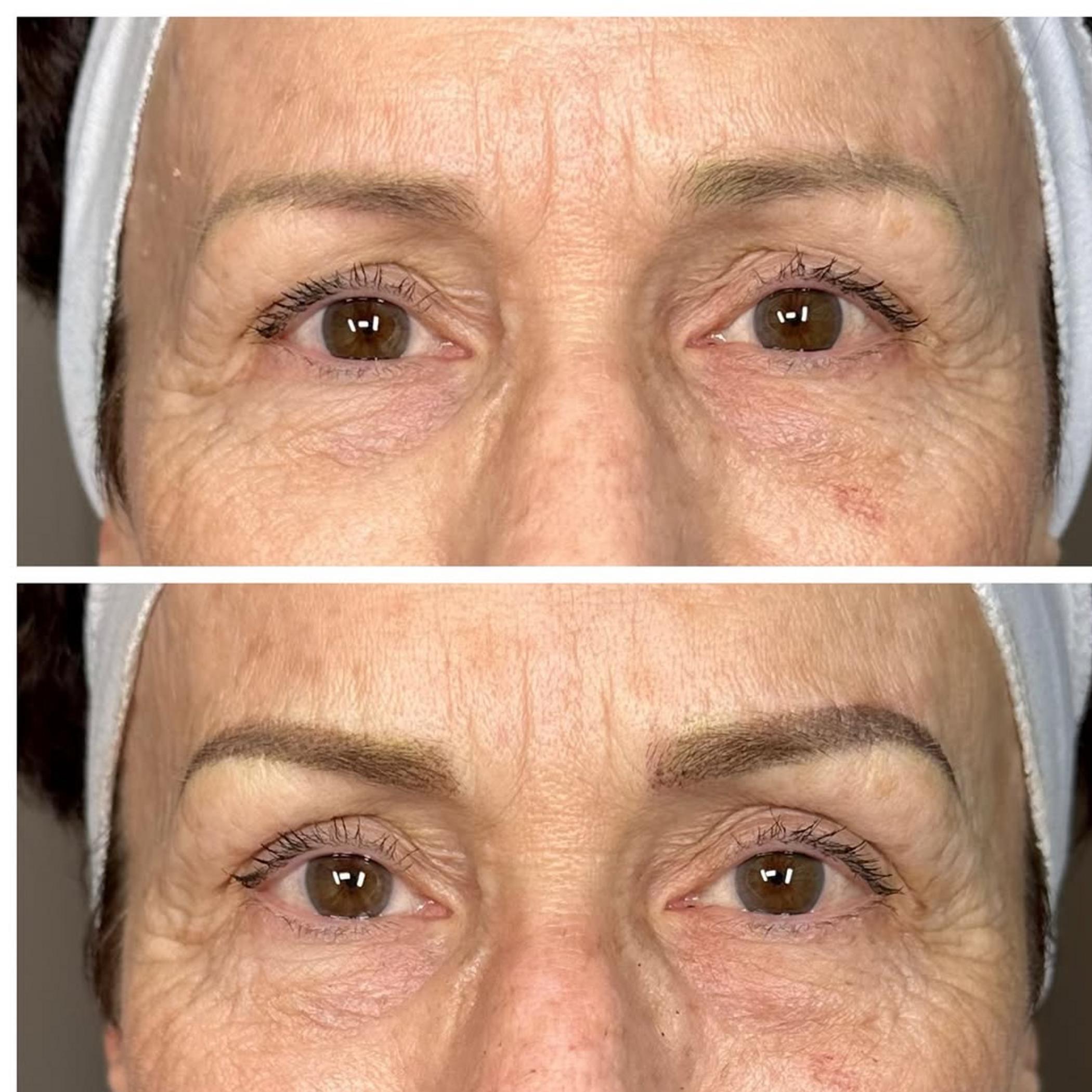 technician performing combo brow procedure